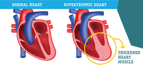 Hypertrophic-Cardiomyopathy
