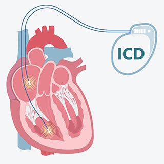 ICD image