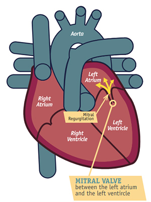 Mitral Valve Regurgitation